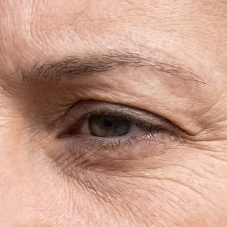 Fine Lines & Wrinkles